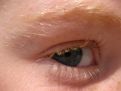 Young eye